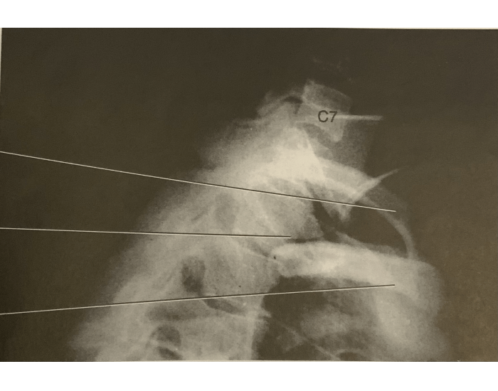 Twining Method Radiography Lateral cervical thoracic region twinning method Quiz