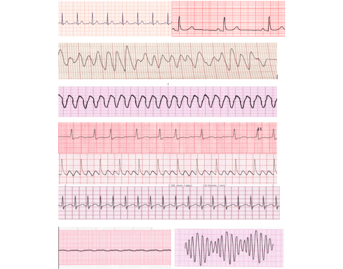 basic-ekg-strips-quiz for Free Printable Ekg Practice Worksheets Basic EKG Strips Quiz for Free Printable Ekg Practice Worksheets
