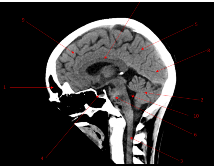 Ct Scan Brain Label Ct Anatomy Of The Brain Head CT Scan Procedure RadTechOnDuty