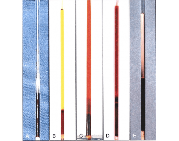 Pcv Color Chart PCV serum color Quiz