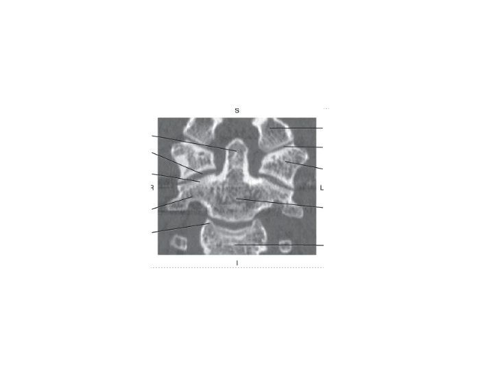 Ct Cap R1 R2 R3 R2format Exam 2: Coronal CT reformat of C1 and C2 Quiz