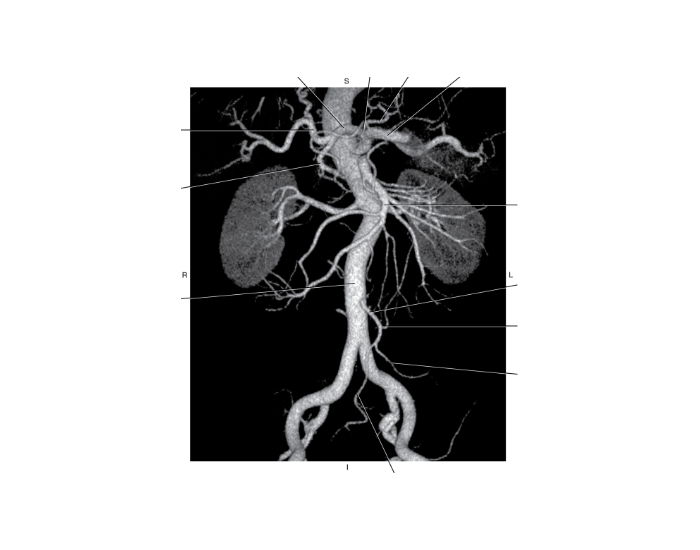 Exam 3: 3D CTA of inferior mesenteric artery (IMA) Quiz