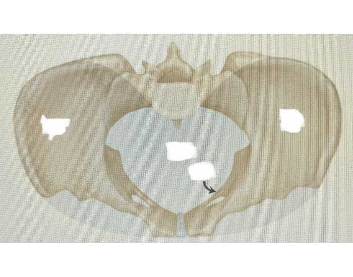 DMS 115: True and False Pelvis — Printable Worksheet