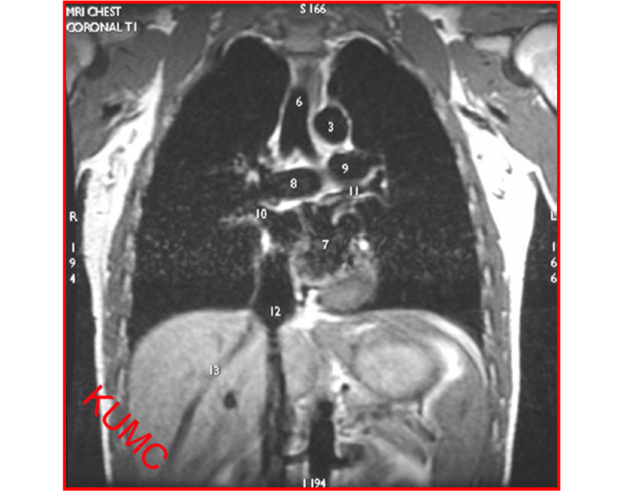 Chest Mri Sample MRI T1 Coronal Chest image Quiz