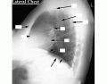 Lateral Chest Xray 