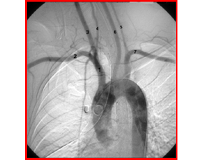 Aortic arch angiogram (RPO) Quiz