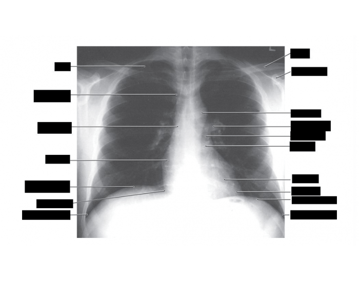 Chest Radiograph Quiz