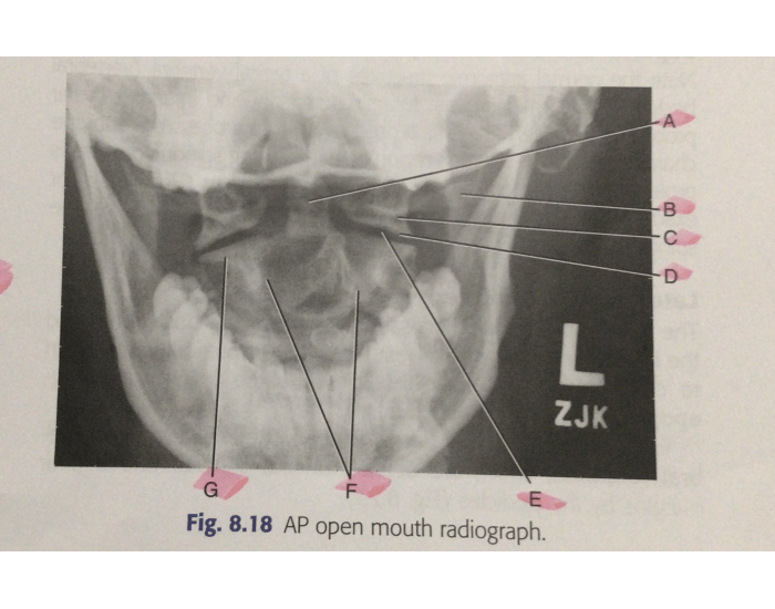 Odontoid xray anatomy Quiz