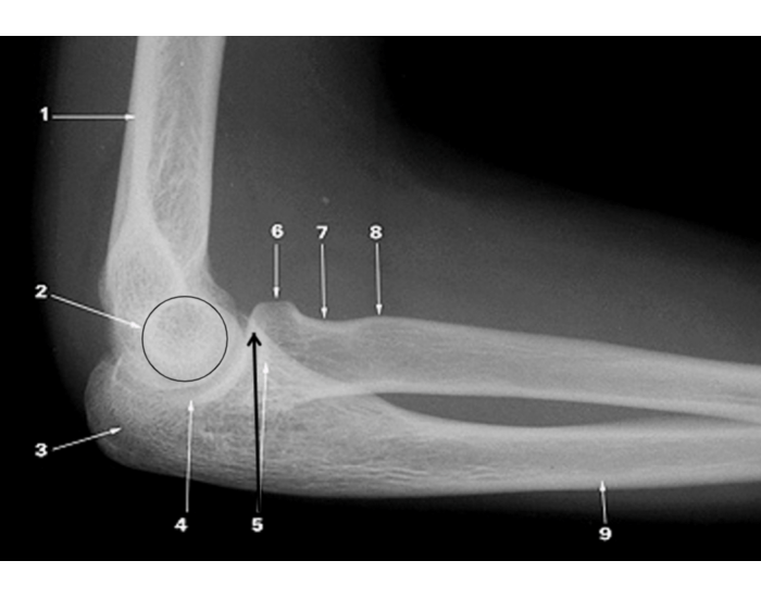 Elbow Labr Radiograph lateral elbow radiograph Quiz
