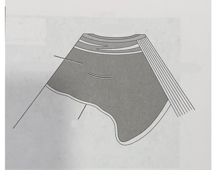 what is free fluid in the posterior cul de sac