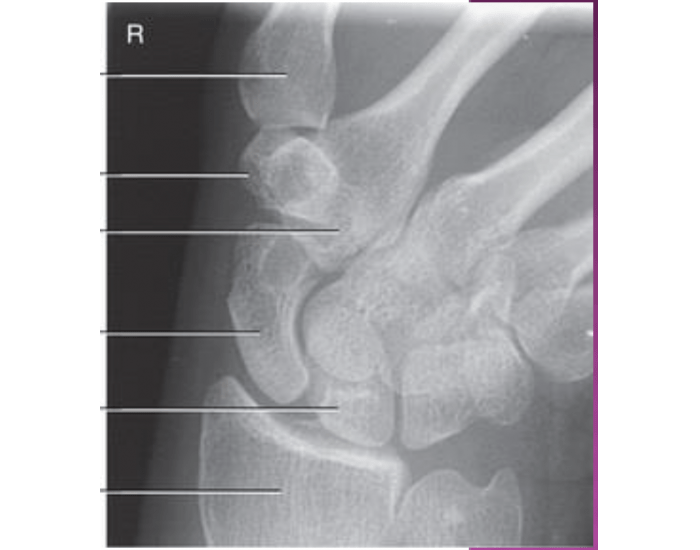 PA ulnar deviation radiography Quiz