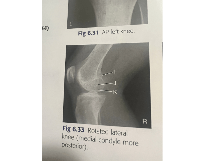 Rotated lateral knee Quiz