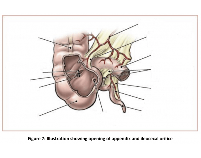 Appendixorifice Appendix and Iliocecal Orifice Quiz