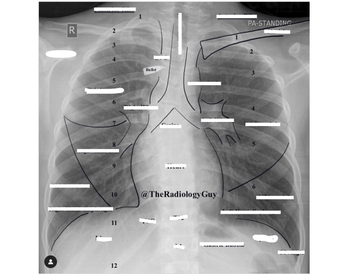 Chest Radiography Anatomy — Printable Worksheet