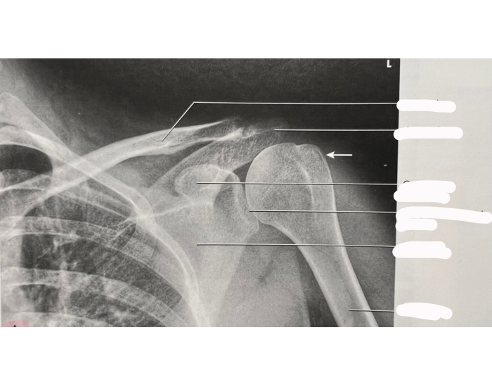 AP shoulder, external rotation humerus Quiz