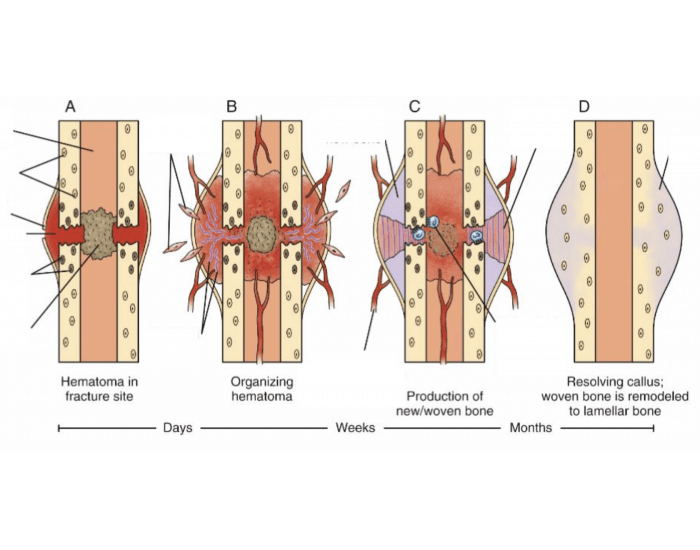 bone healing; temporal changes in callus formation Quiz