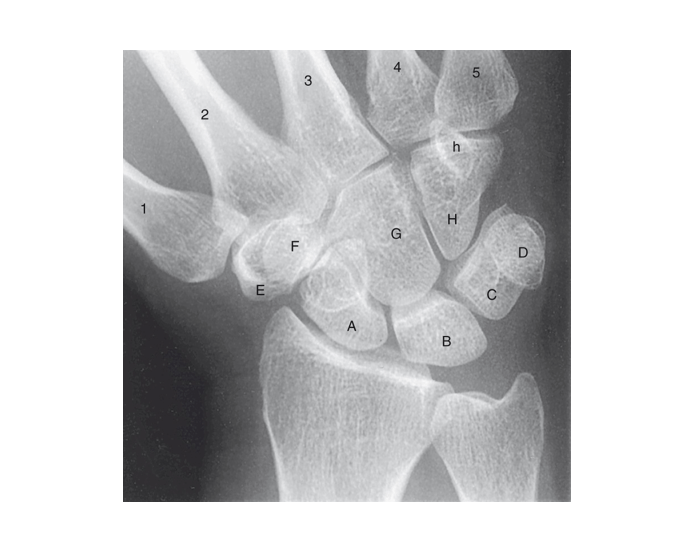Radial View Radiograpbh Radiograph Radial Deviation Quiz