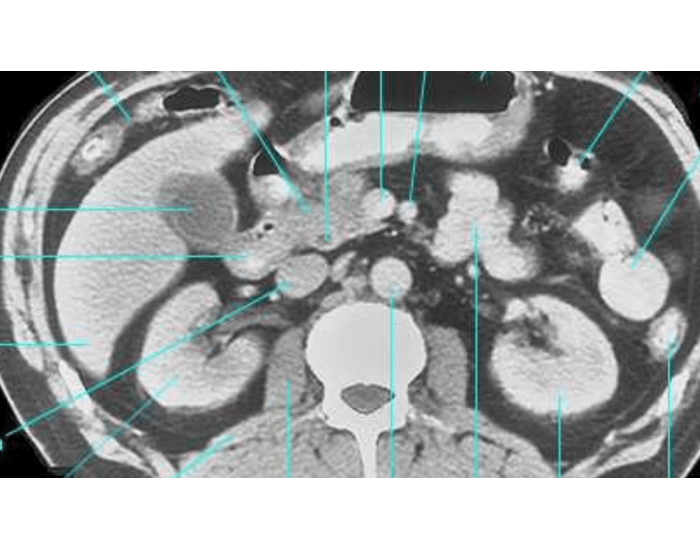 Ct Scan Worksheet.pdf CT scan abdomen — Printable Worksheet