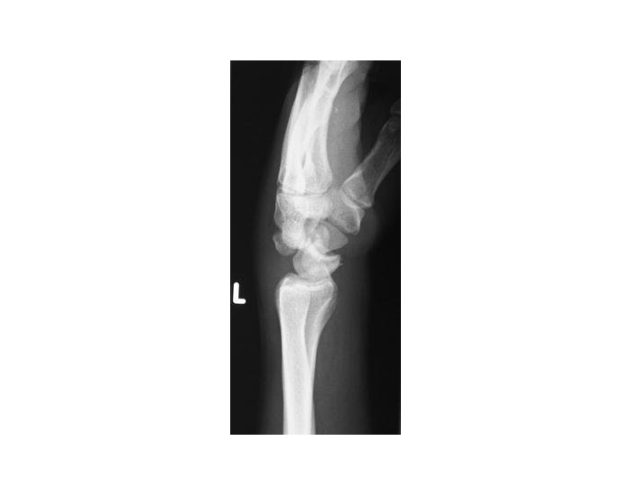Distal Humerus Labeling — Printable Worksheet