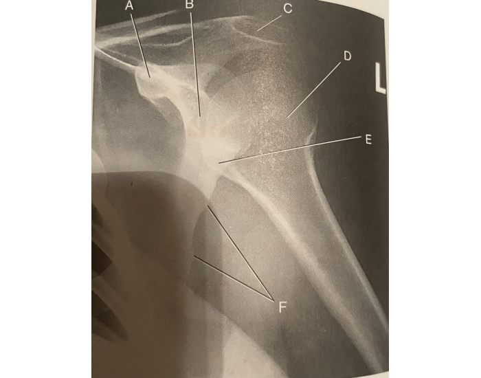 Internal rotation of humerus — Printable Worksheet