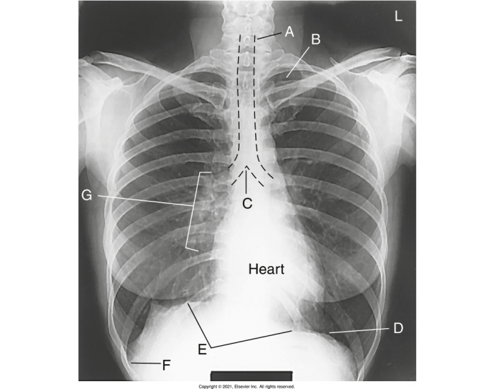 Bone Labelling Chest AP chest x-ray labeling anatomy — Printable Worksheet