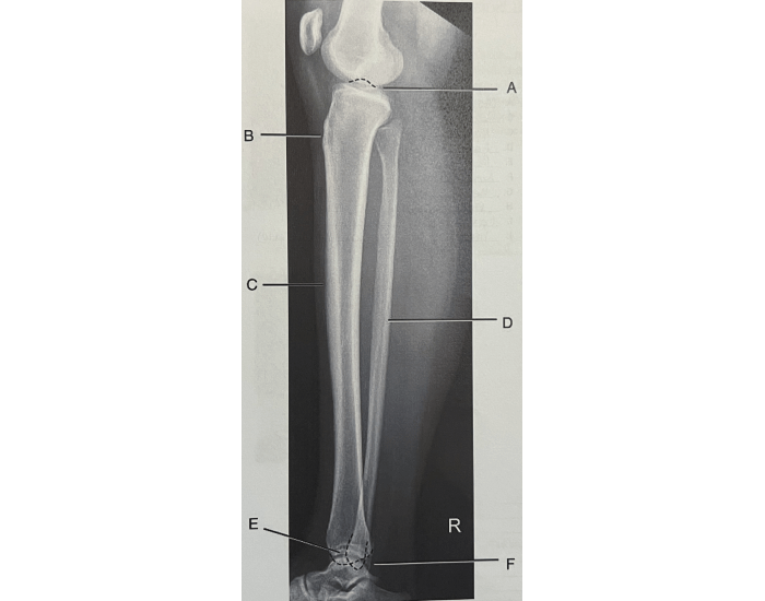 Tibia & Fibula Anatomy — Printable Worksheet