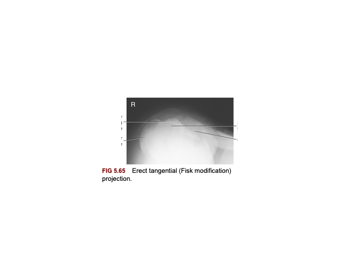 erect tangential (fisk projection) Quiz