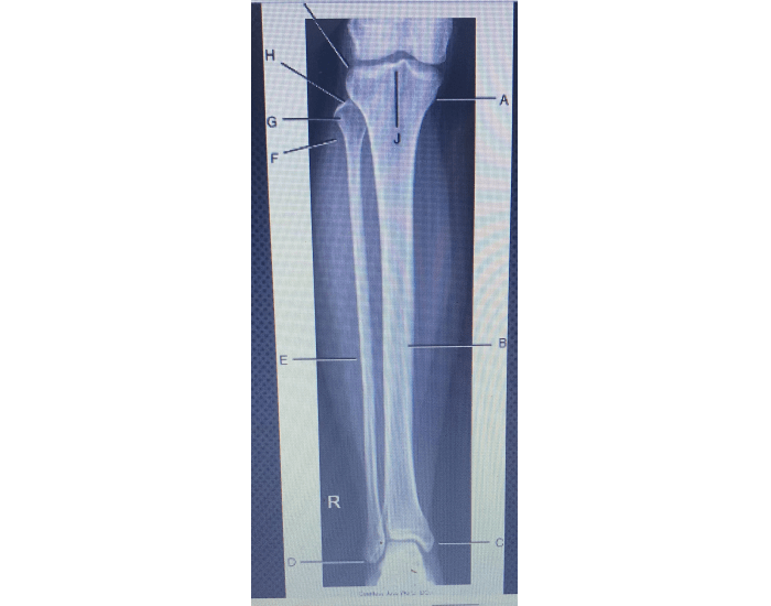 ap of tibia and fibula — Printable Worksheet