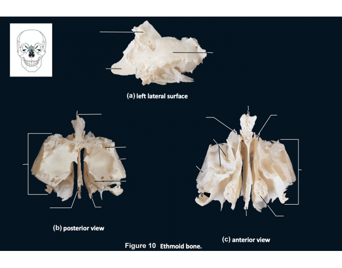 Ethmoid Bone Quiz