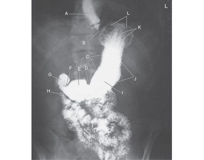 Upper GI radiograph Quiz