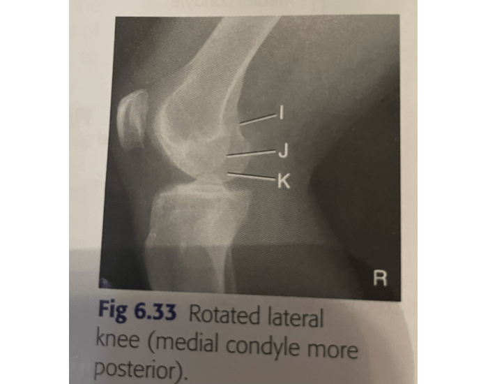 rotated lateral knee Quiz