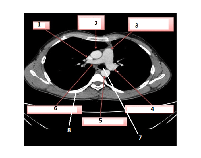 Ct Scan Worksheet.pdf Thorax CT Scan 2 — Printable Worksheet