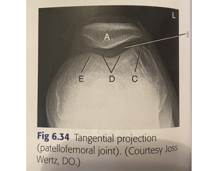 Tangential Projection Radiograph tangential projection of patellofemoral joint Quiz