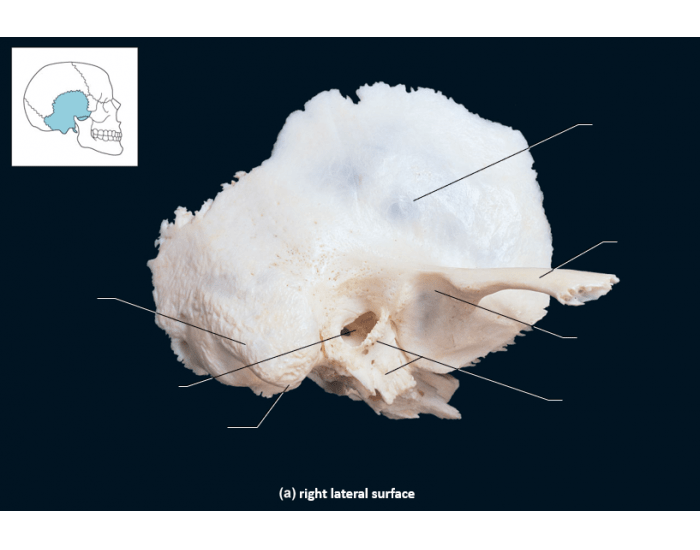 Temprtal Ridge Temporal Bone (Right Lateral Surface) — Printable Worksheet