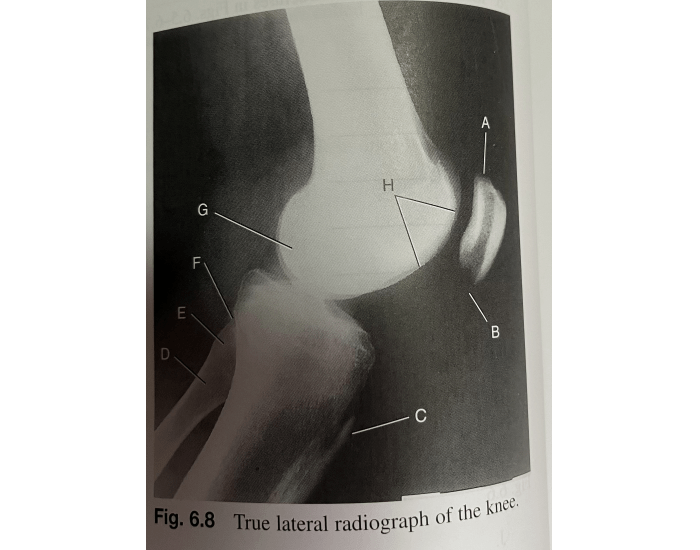Tibia and Fibula- lateral view — Printable Worksheet