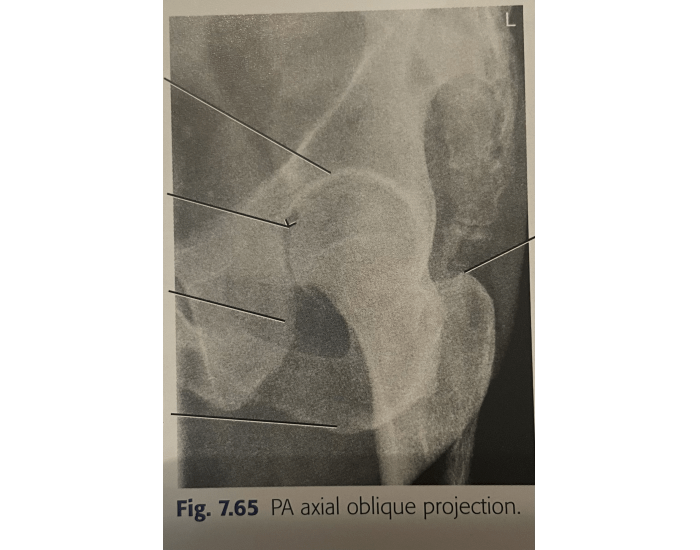 Tuefel Method PA axial oblique projection Quiz