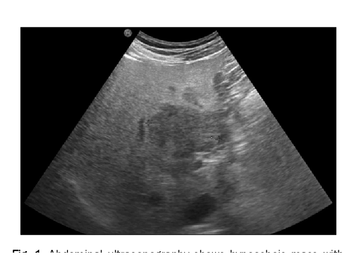 Focal Fatty Sparing of the Liver Quiz