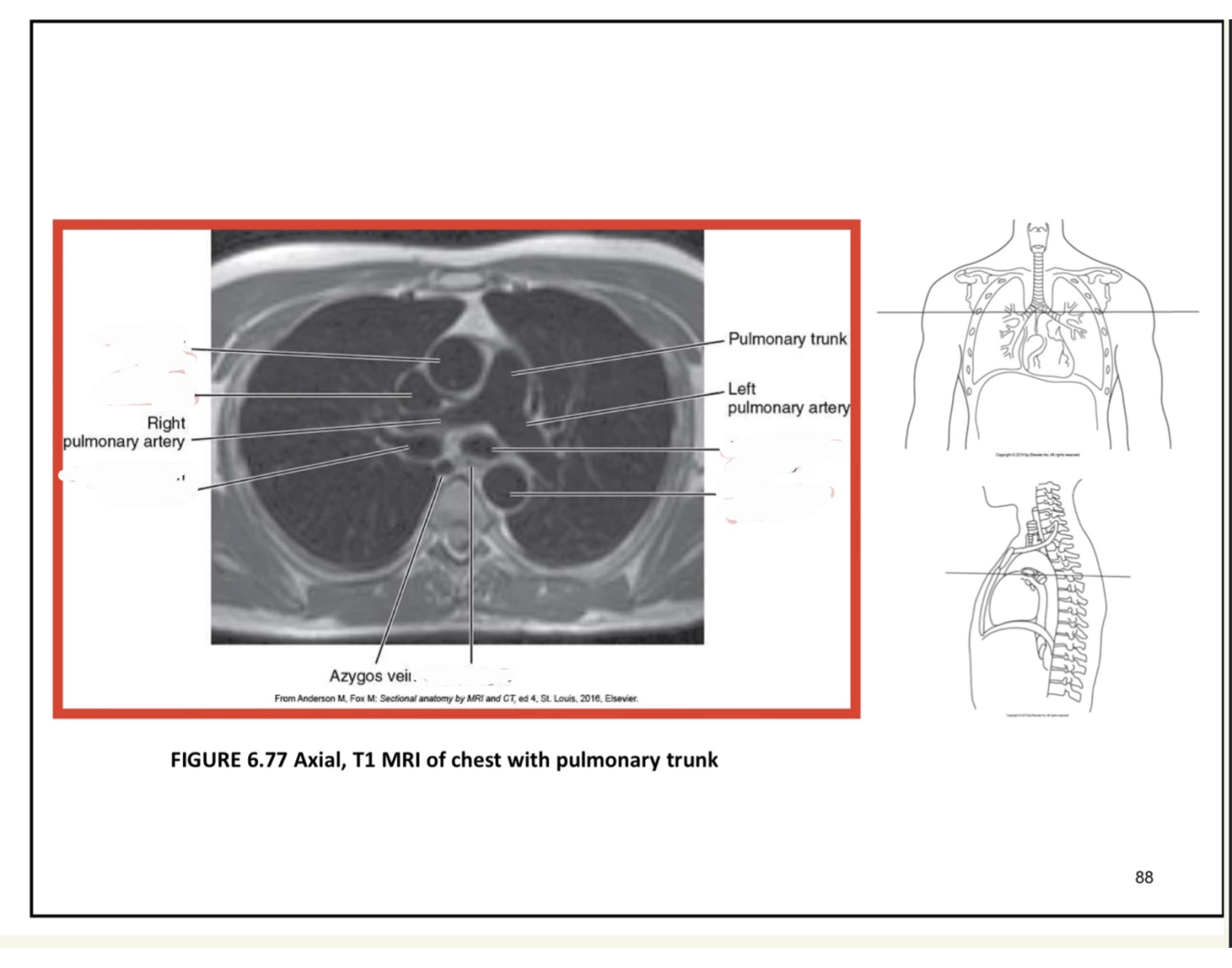 Chest Mri Sample Axial MRI of chest with pulmonary trunk Quiz