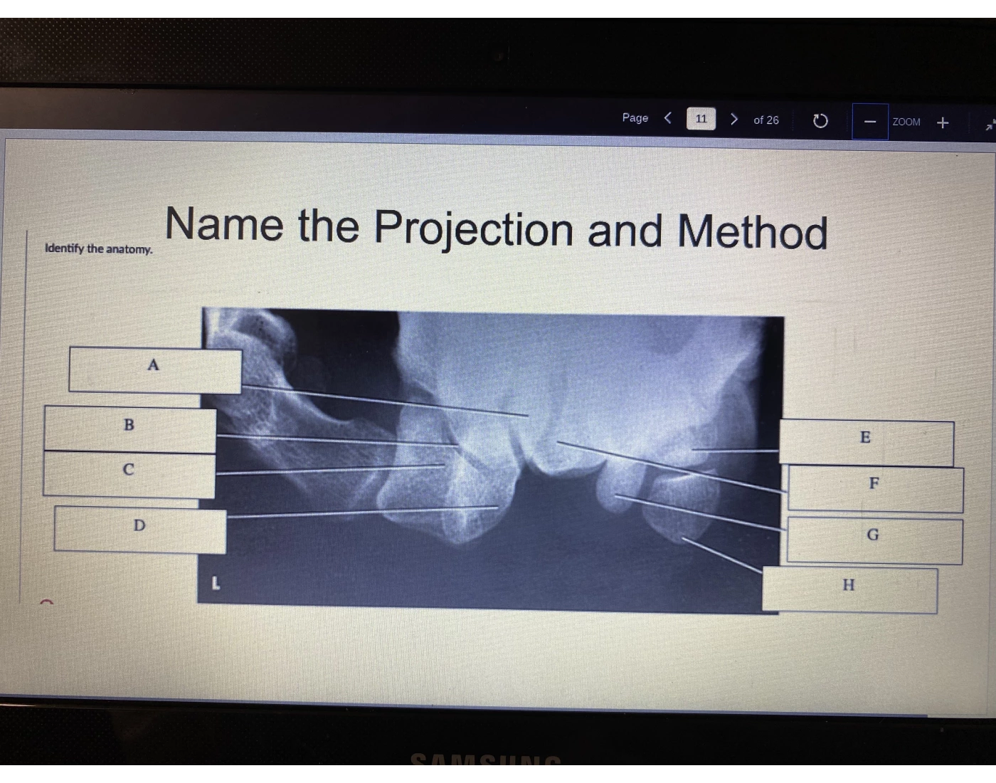 Wrist projection Quiz