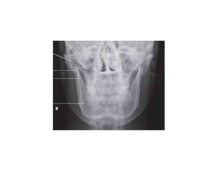 PA Mandibular Rami Quiz