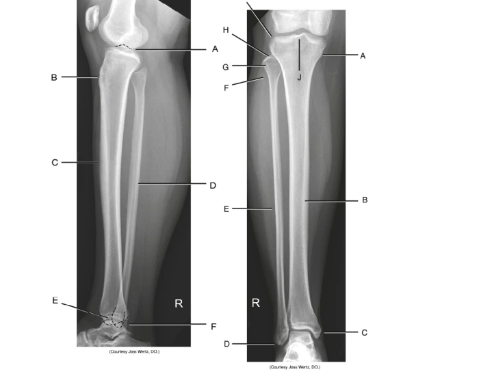 LAT. & AP tibfib xray labeling Quiz
