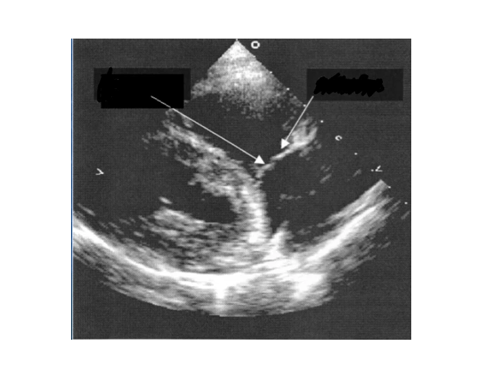 RV inflow TV leaflets Quiz