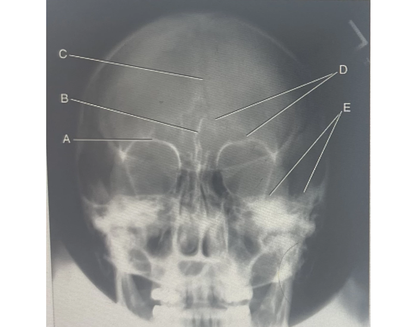 Positioning 4 Caldwell Anatomy Quiz