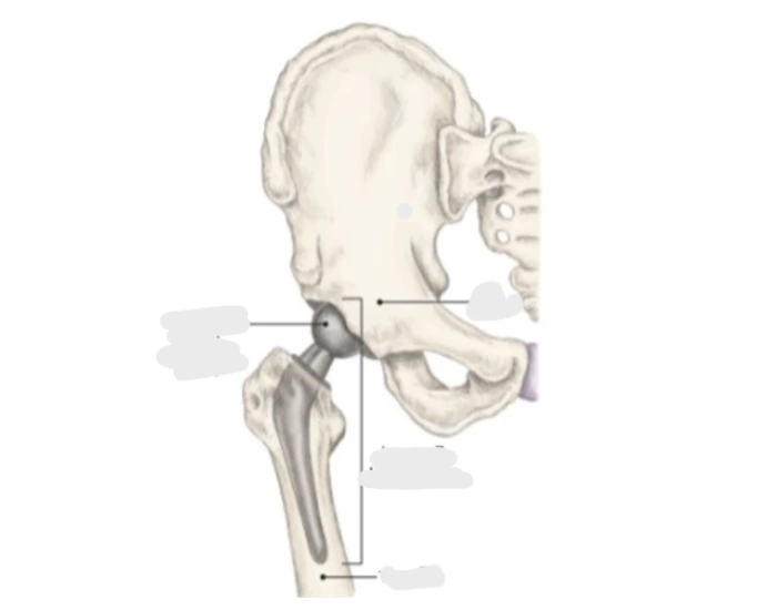 Hip replacement Quiz