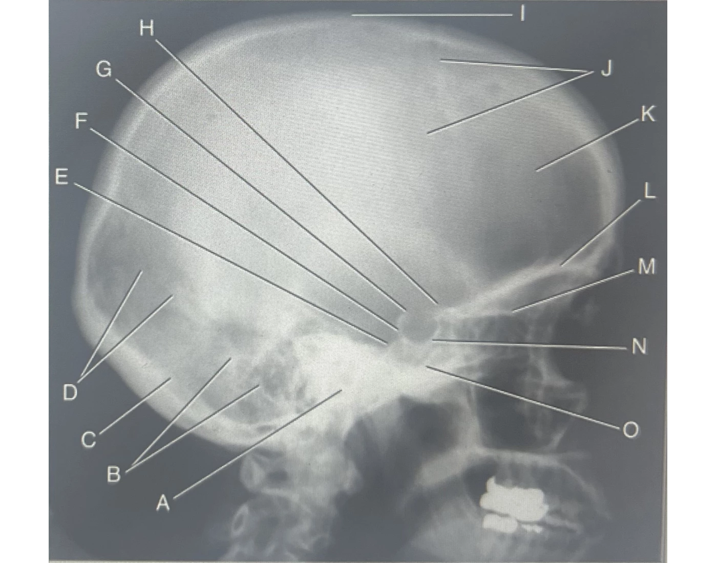 Lateral Radiograph Skull Anatomy Quiz