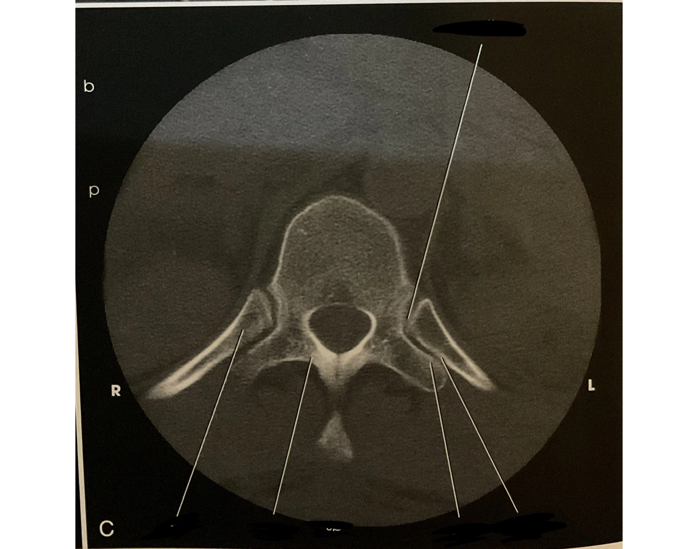 Greyhound Rib Scan CT scan of tspine and rib Quiz
