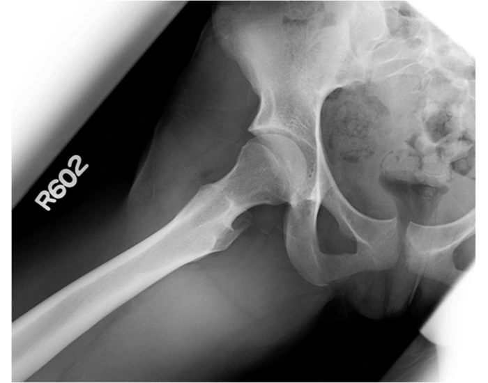 Frog Lateral Modified Frog Lateral Hip Quiz