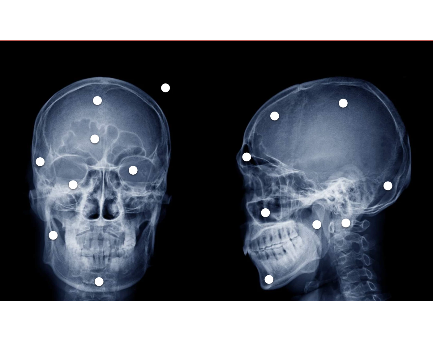 skull PA caldwell and lateral Quiz