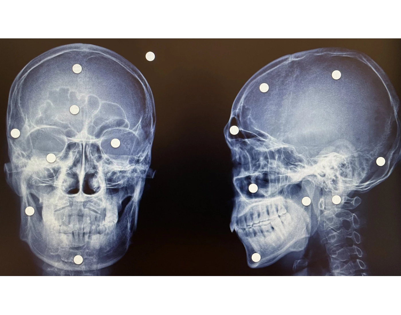 PA Caldwell and Lateral- Skull Xray — Printable Worksheet