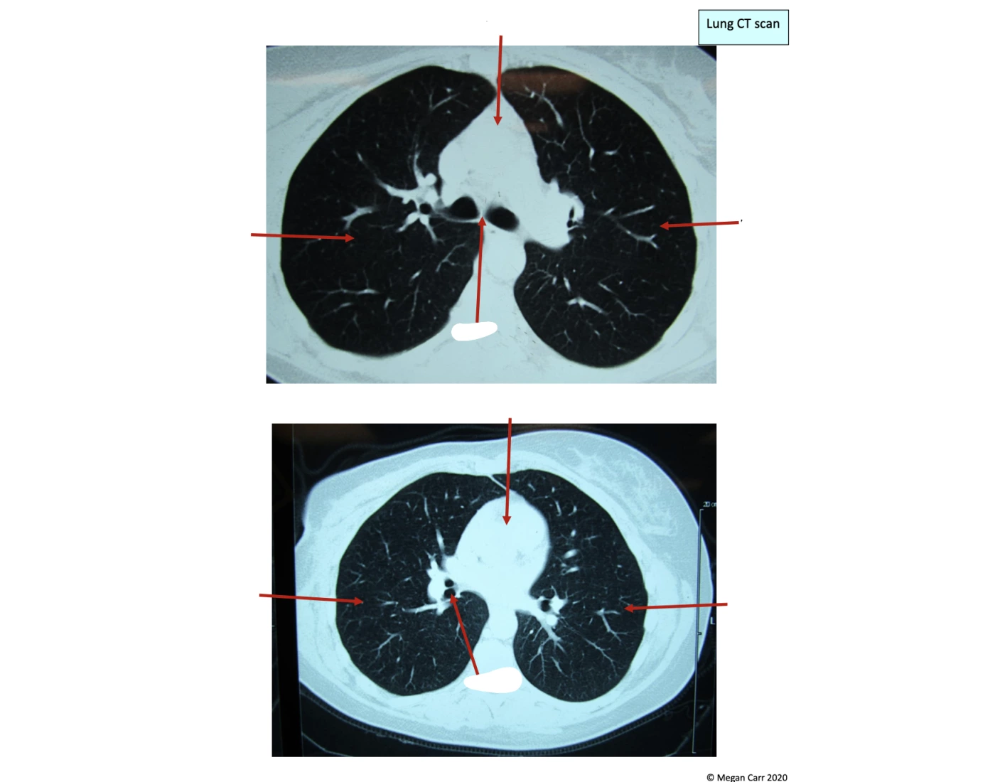 Ct Scan Worksheet.pdf Lung CT scan — Printable Worksheet